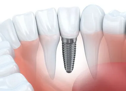 illustration of teeth in gums, embedded dental implant next to teeth, dental implants Hauppauge, NY implant dentist
