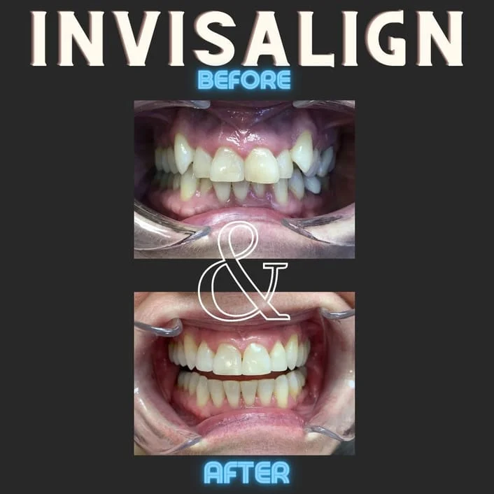 Invisalign Before & After - St Louis, MO Dentist | Concord Dental Group Invisalign Before & After - St Louis, MO Dentist | Concord Dental Group