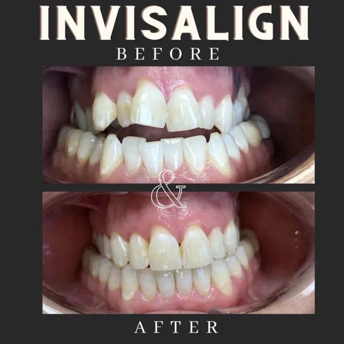 Invisalign Before & After - St Louis, MO Dentist | Concord Dental Group