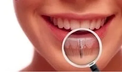 woman's mouth showing embedded dental implants Elgin, IL dentist