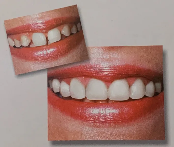 Veneers in Reston, VA