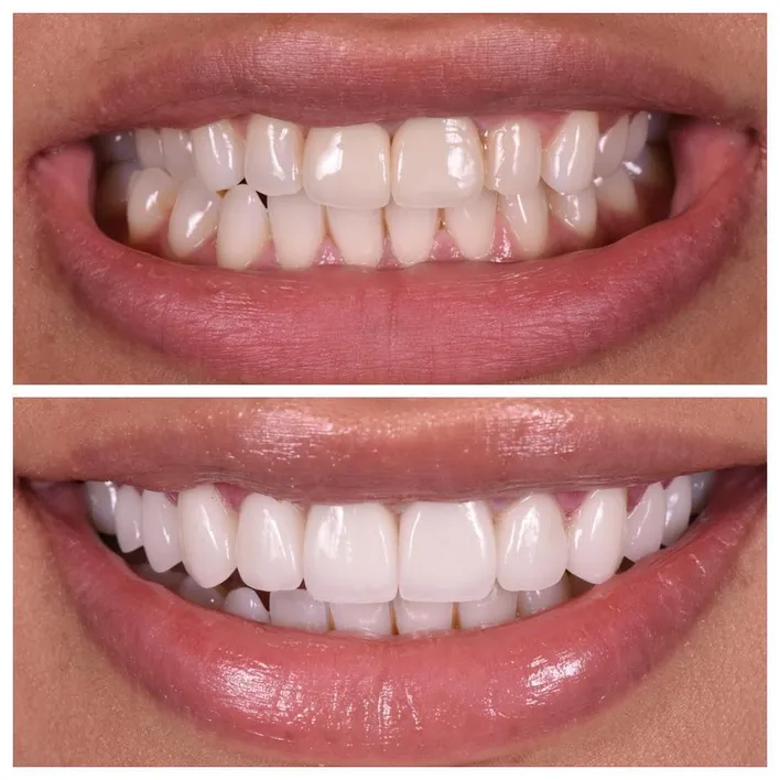 veneers