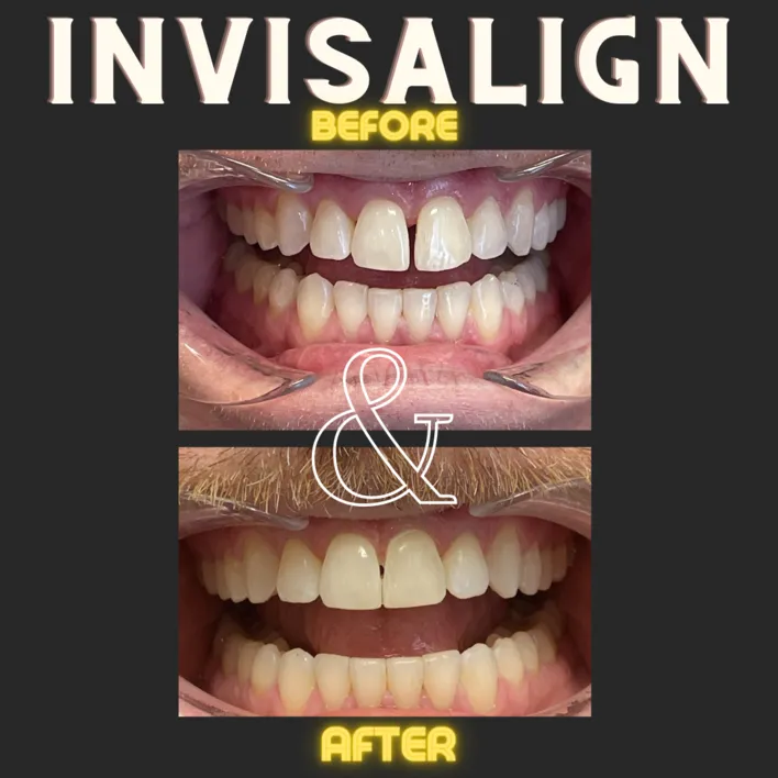 Invisalign Before & After - St Louis, MO Dentist | Concord Dental Group