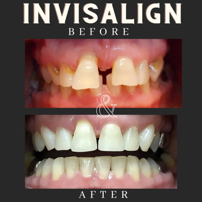 Invisalign Before & After - St Louis, MO Dentist | Concord Dental Group