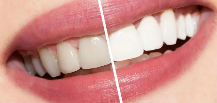 Whitening