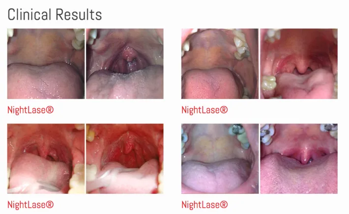 nightlase before and after