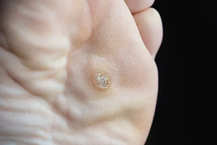 plantar warts