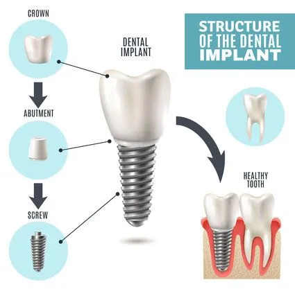 Illustrated diagram "Structure of the Dental Implant" showing implant parts, dental implant specialist Miramar, FL dental implant center
