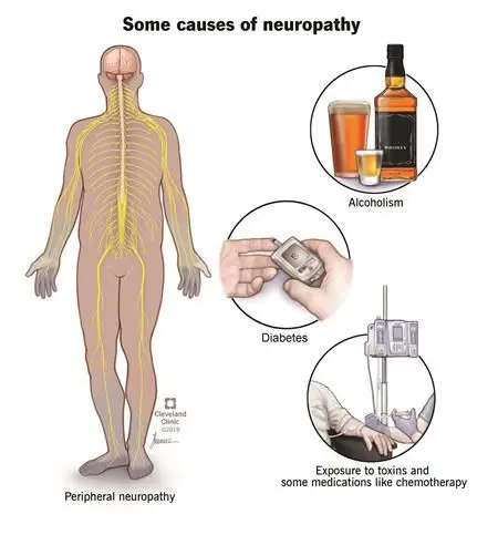 neuropathy