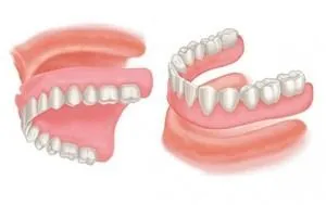 illustration showing complete upper and lower dentures being placed over gums in mouth, dentist Elgin, IL dentures