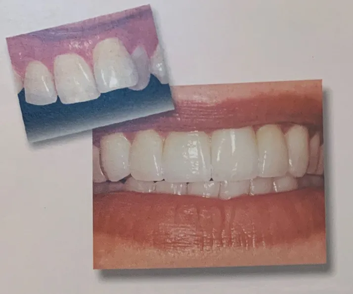 Veneers in Reston, VA