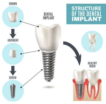 Illustrated diagram "Structure of the Dental Implant" showing implant parts and placement in gums, dental implant restoration Leesburg, VA dentist
