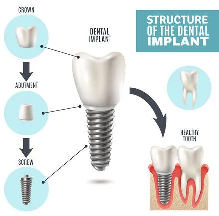 "Structure of the Dental Implant" illustrated diagram showing implant parts, dental implants Windsor Locks dentist