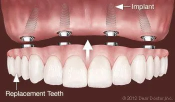 illustration showing implant supported dentures Manteca, CA dentist