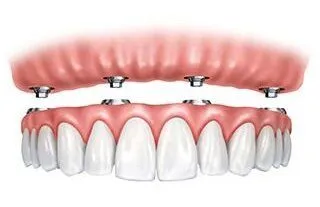 illustration of implant dentures being attached in mouth, implant supported dentures North York, ON restorative dentistry