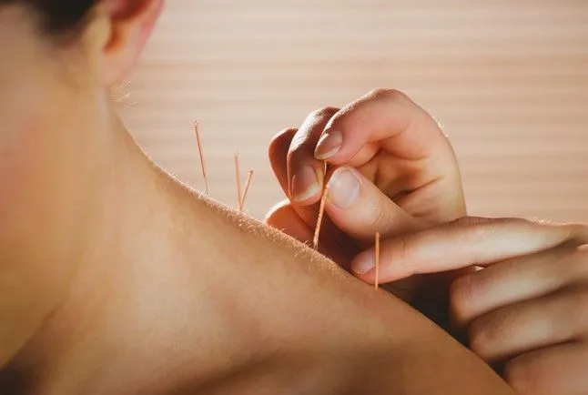 Dry needling