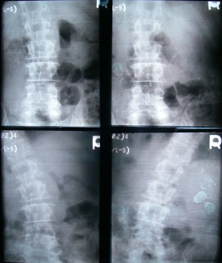 xrays