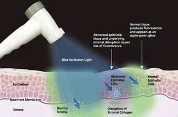 oral_cancer_screening