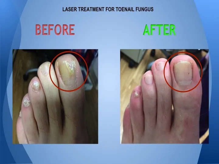 Laser Treatment for Toenail Fungus