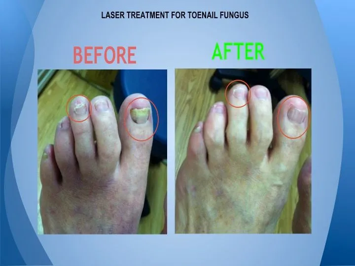 Ingrown Toenail, Alexandria VA, Podiatrist