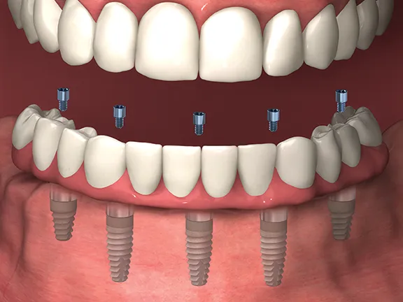 Implant Dentures