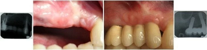 Dental Implants -Mutiple
