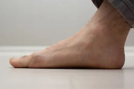 Flat Feet 