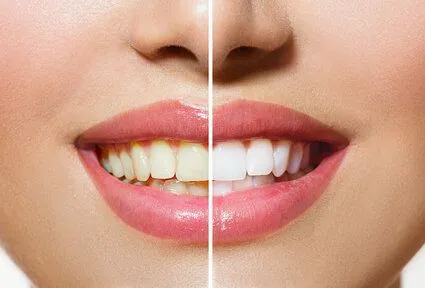 split image showing before and after results on teeth of professional teeth whitening Manteca, CA cosmetic dentistry