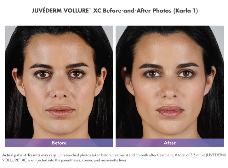 Juvederm-Vollure