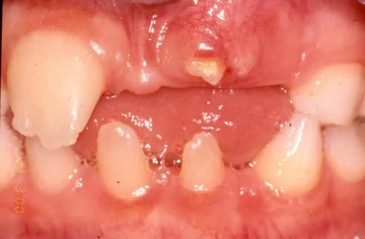 image of child with broken down tooth needing restoration norfolk ma pediatric dentist