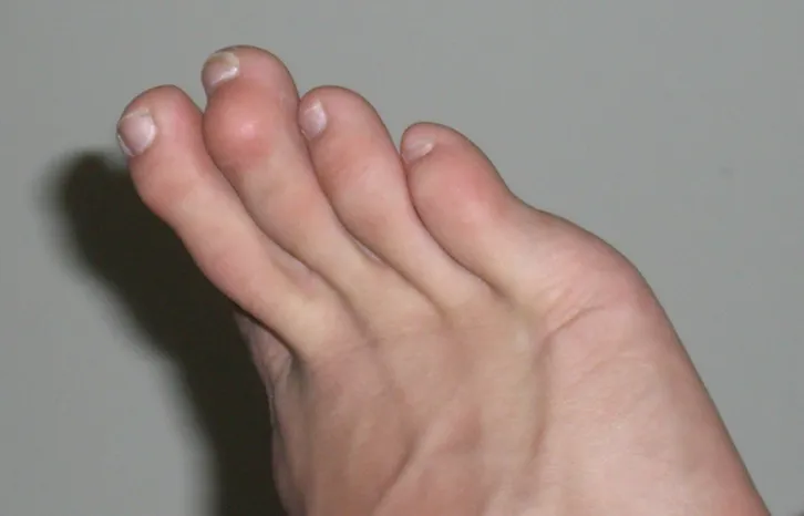 Hammertoes