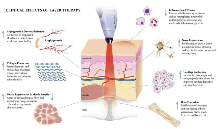 Effects of Laser Therapy