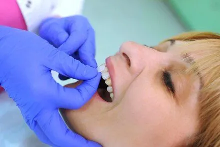 dentist's gloved hands placing dental veneer piece onto woman's front tooth, porcelain veneers Plantation, FL cosmetic dentist