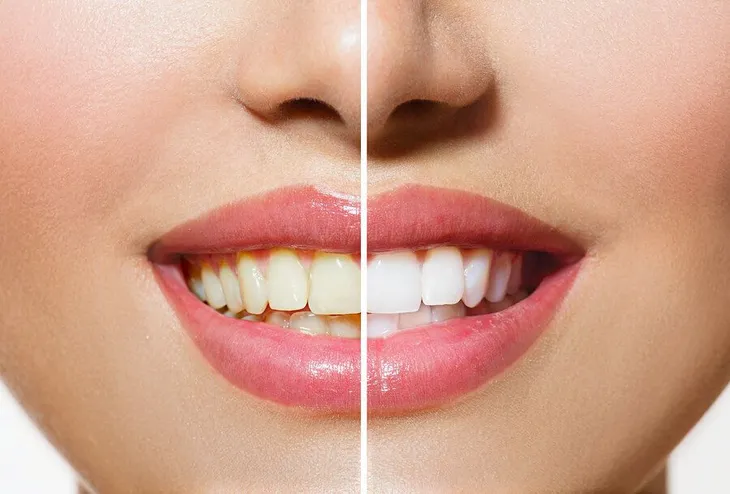 before and after image of yellowed teeth in woman's mouth then white teeth after treatment, teeth whitening Westminster, MD