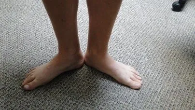 flat_feet2.jpg