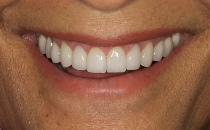 Porcelain Veneers Honolulu