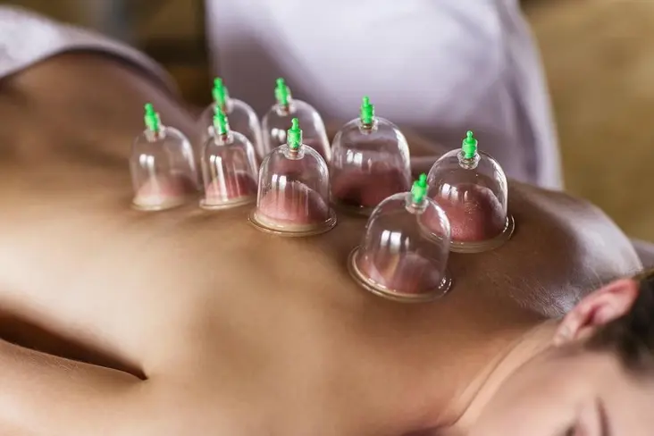 cupping