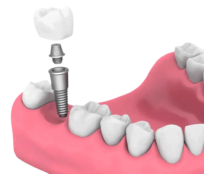 Implant | Dentist In Fircrest, WA | Emerson Dental