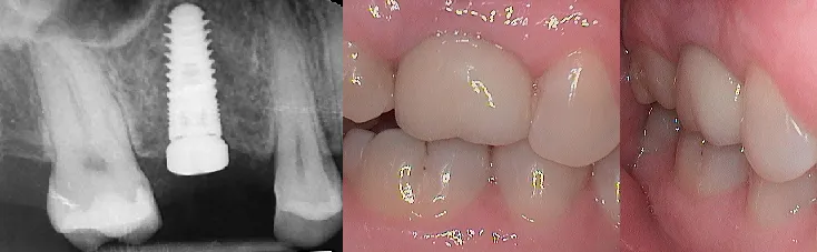 Dental Implants Canton OH
