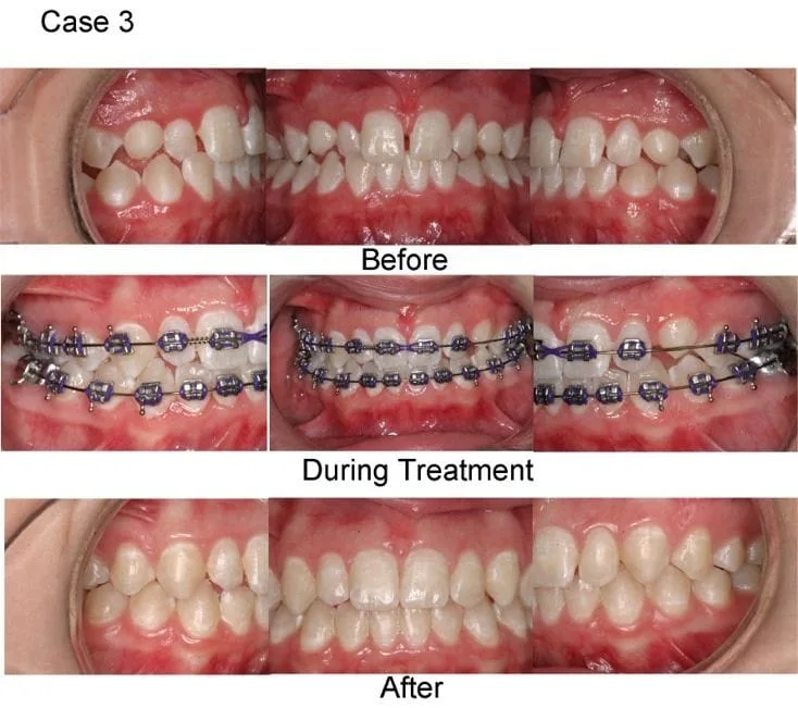 Red Wing dental braces, Straighten teeth MN Dentist