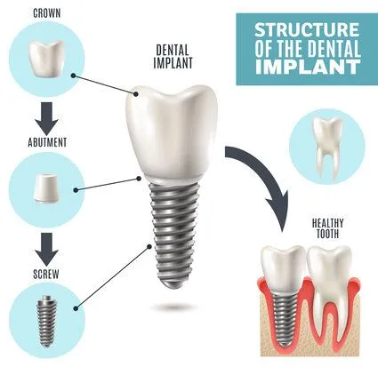 illustrated diagram "Structure of the Dental Implant" showing implant parts and placement, dental implants Longmont, CO dentist