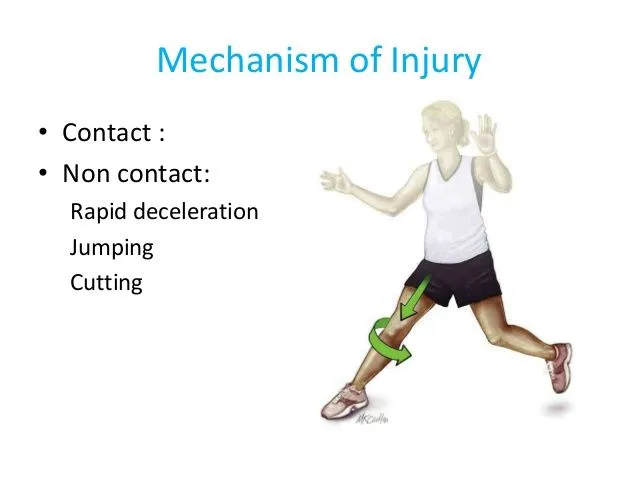 ACL mechanism of injury