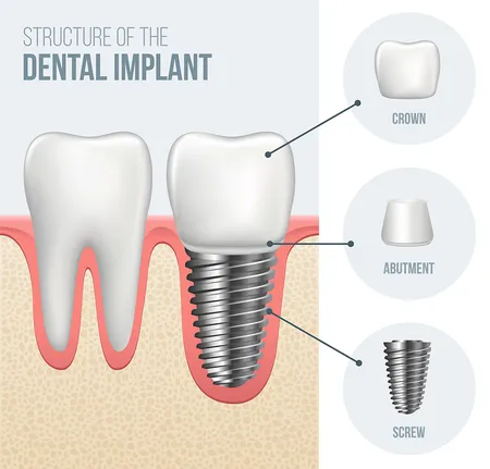 illustration "Structure of the Dental Implant" showing dental implant with crown tooth attached, parts of implant labeled, dental implants Roslyn, NY dentist