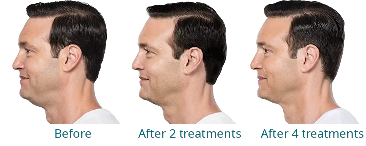 Kybella treatment results
