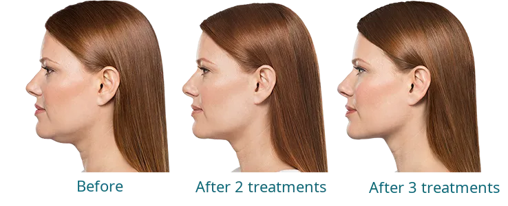 Kybella treatment results