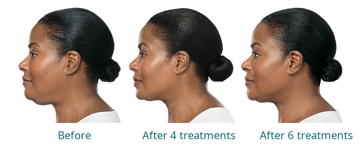Kybella treatment results