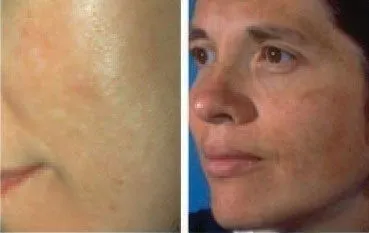 Melasma_symptoms.jpg