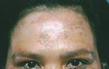 melasma-landing.jpg
