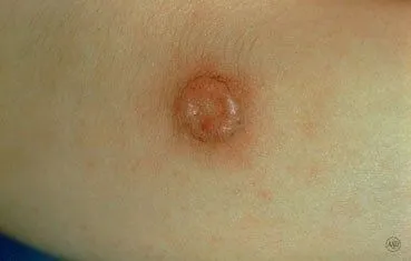 Moles_types_spitz-nevus.jpg