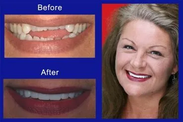 porcelain veneers restoration